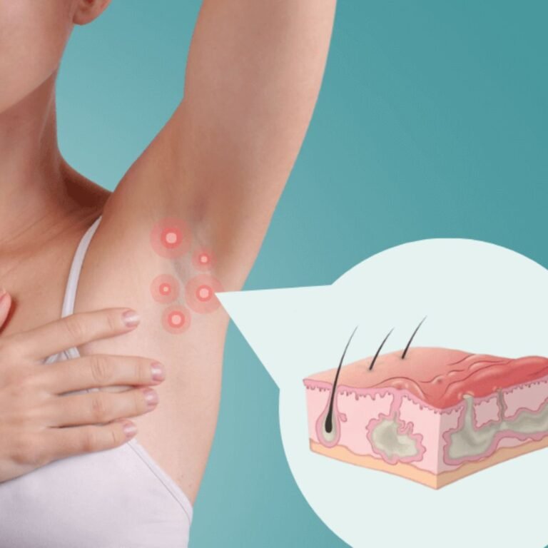 How Do Seasonal Changes Affect People with Hidradenitis Suppurativa?